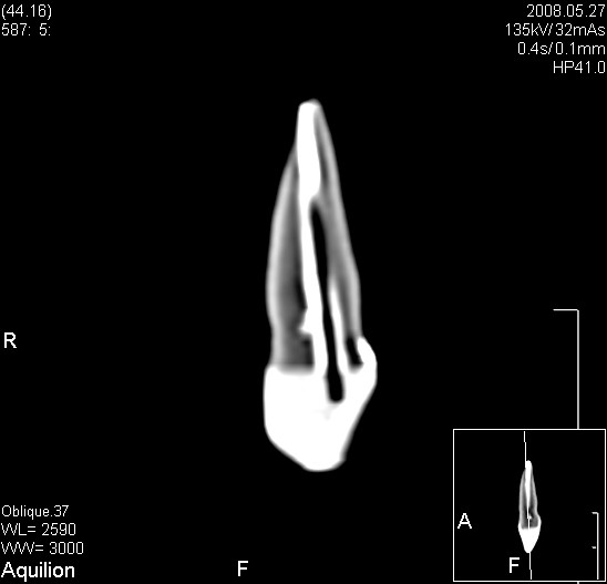 Skan tomograficzny analizowanego zęba